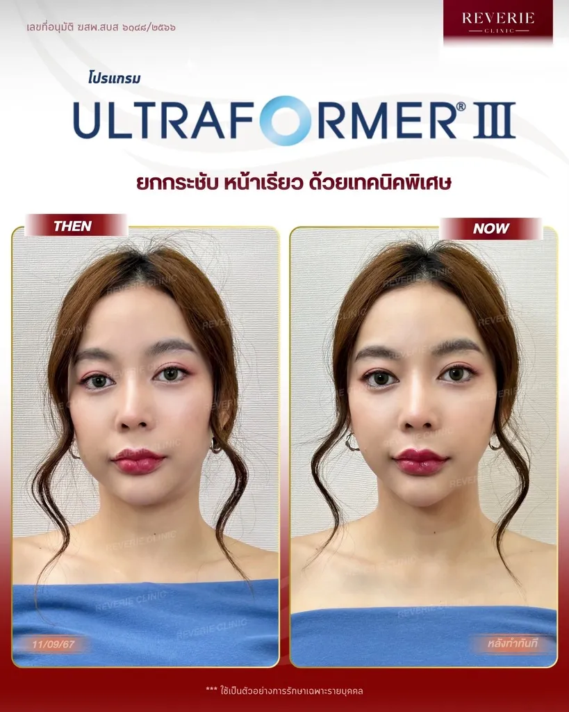 โปรแกรม Ultraformer III-01