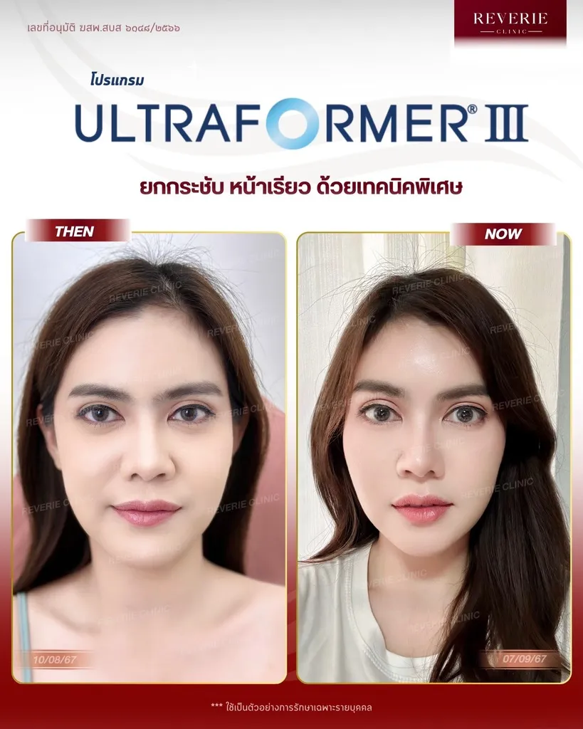 โปรแกรม Ultraformer III-03