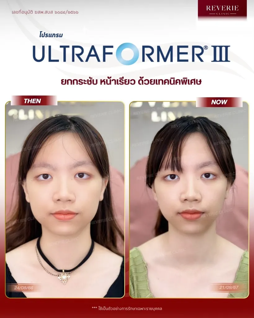 โปรแกรม Ultraformer III-05