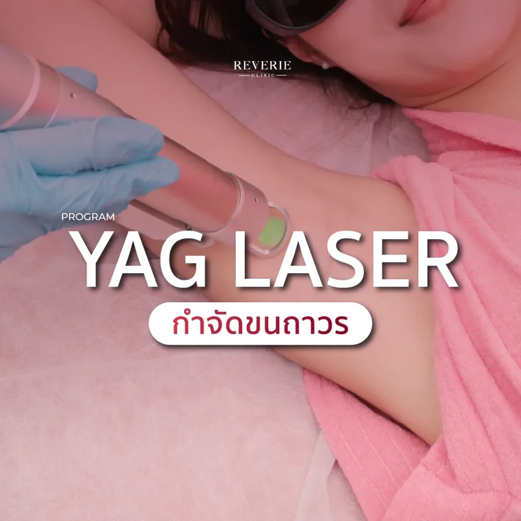 กำจัดขนถาวร