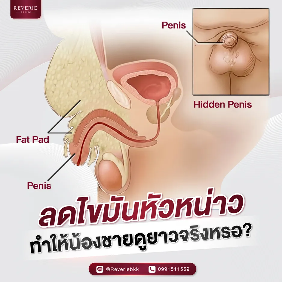 ลดไขมันหัวหน่าว ทำให้น้องชายดูยาวจริงหรอ?