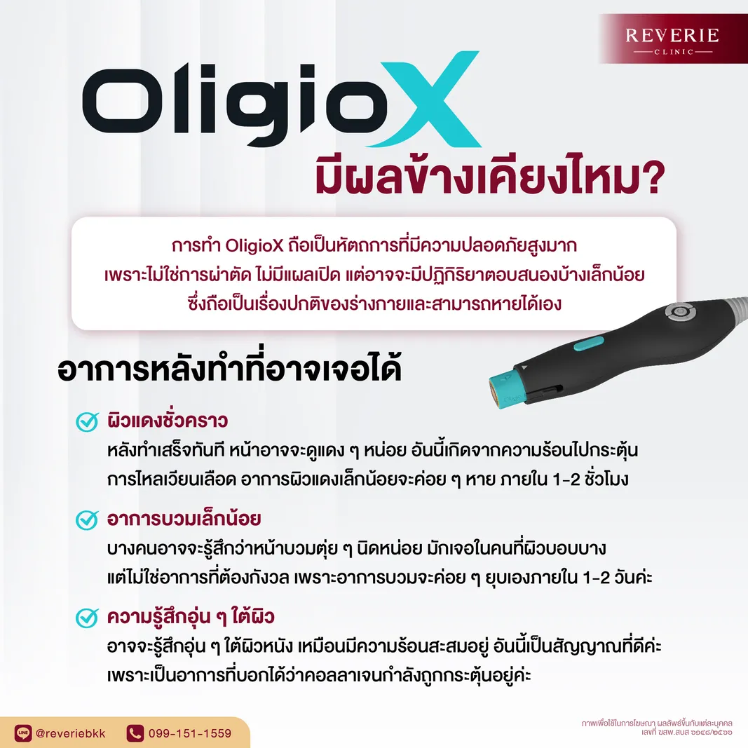 OligioX มีผลข้างเคียงไหม? อาการหลังทำที่อาจเจอได้