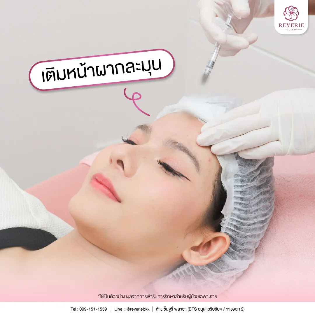 การฉีดเติมหน้าผาก