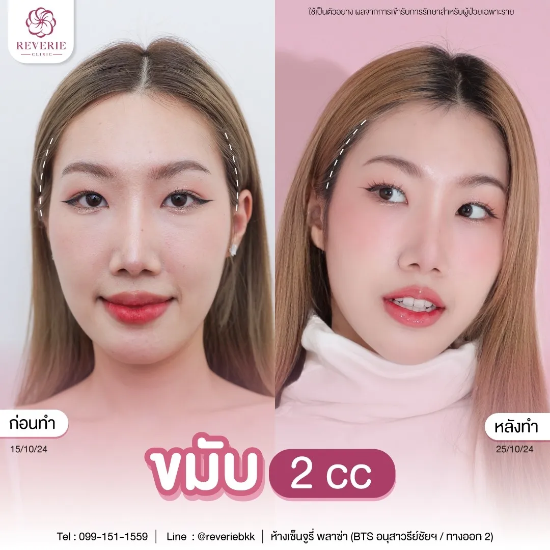 รีวิวเคสเติมเต็มขมับ หน้าผาก