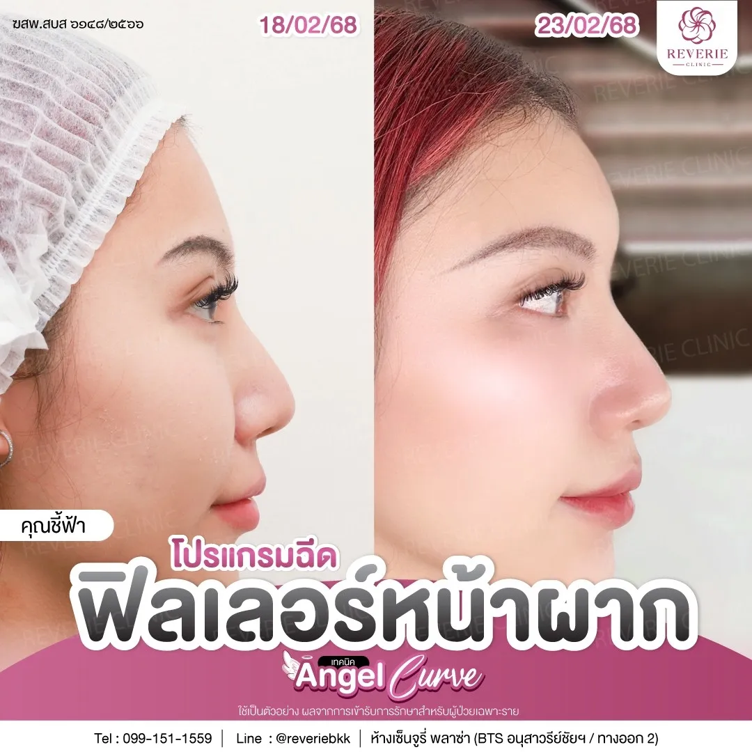 โปรแกรมฉีดฟิลเลอร์หน้าผาก เทคนิค Angel Curve