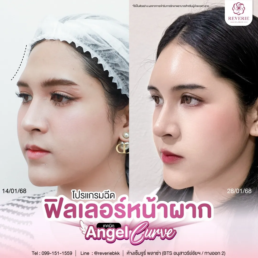โปรแกรมฉีดฟิลเลอร์หน้าผาก เทคนิค Angel Curve