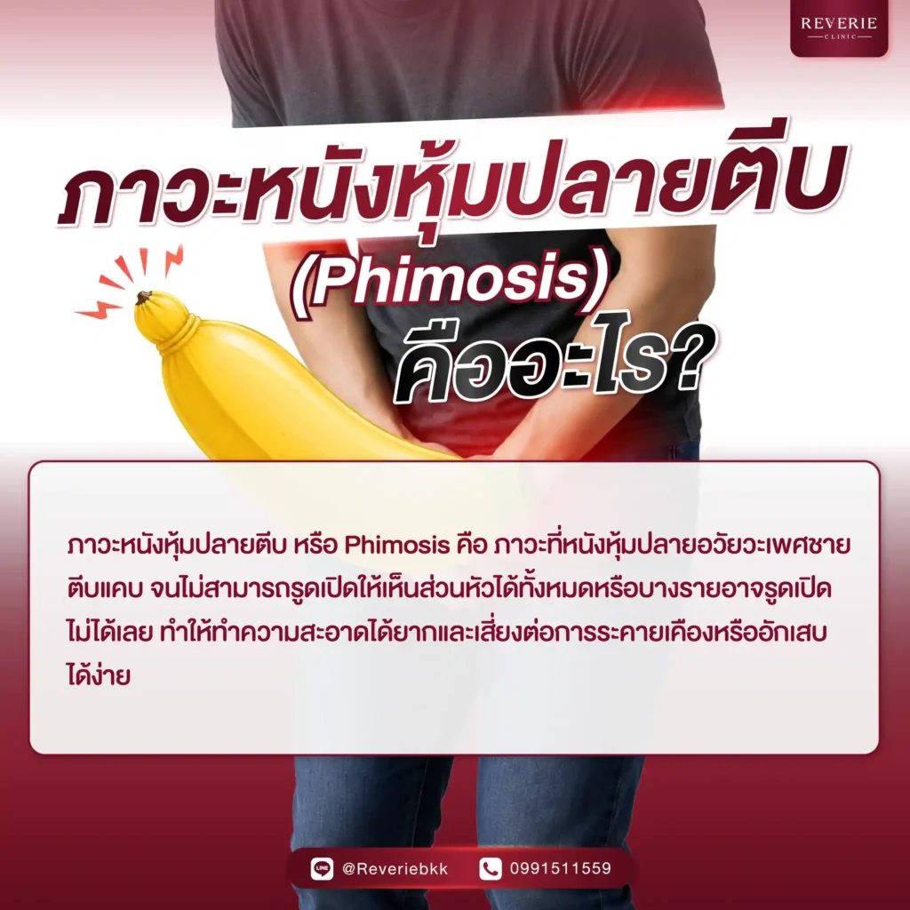 ภาวะหนังหุ้มปลายตีบ (Phimosis) คืออะไร
