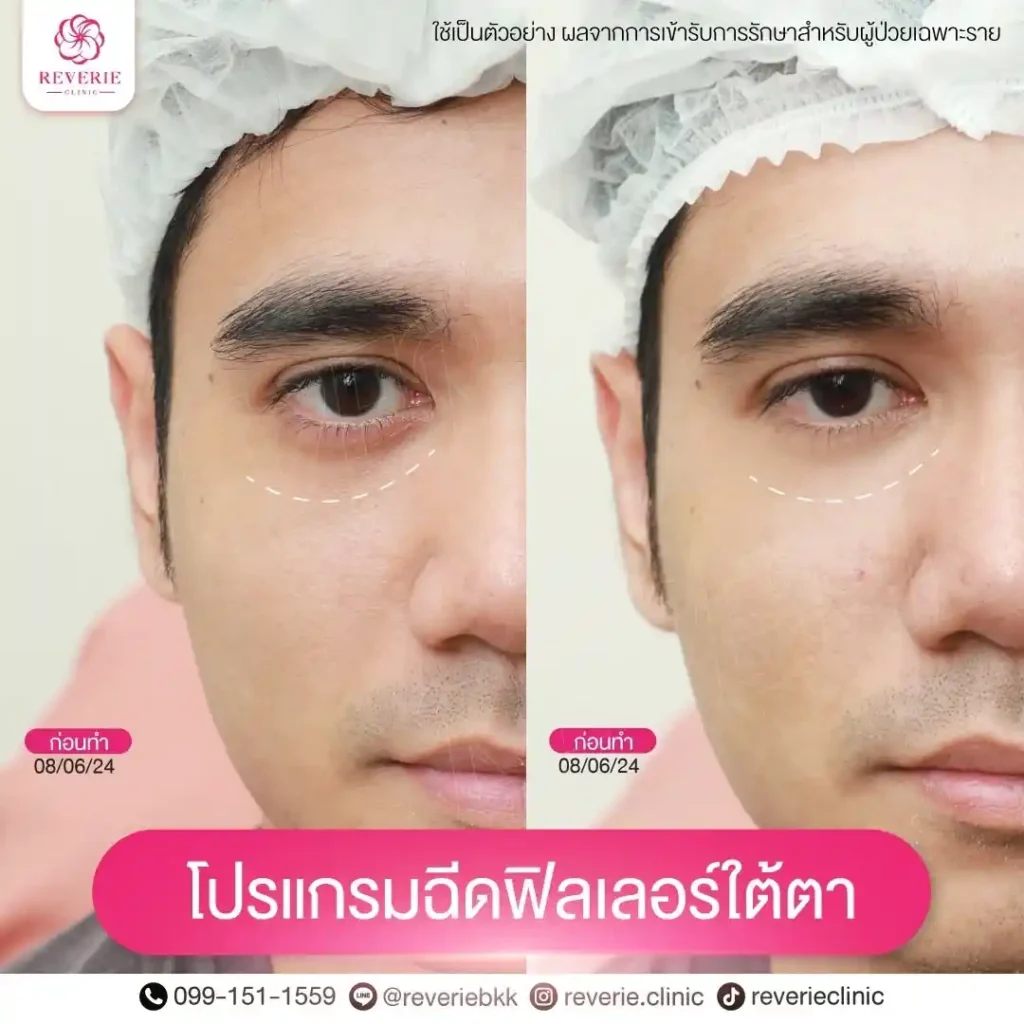 ฟิลเลอร์ใต้ตา