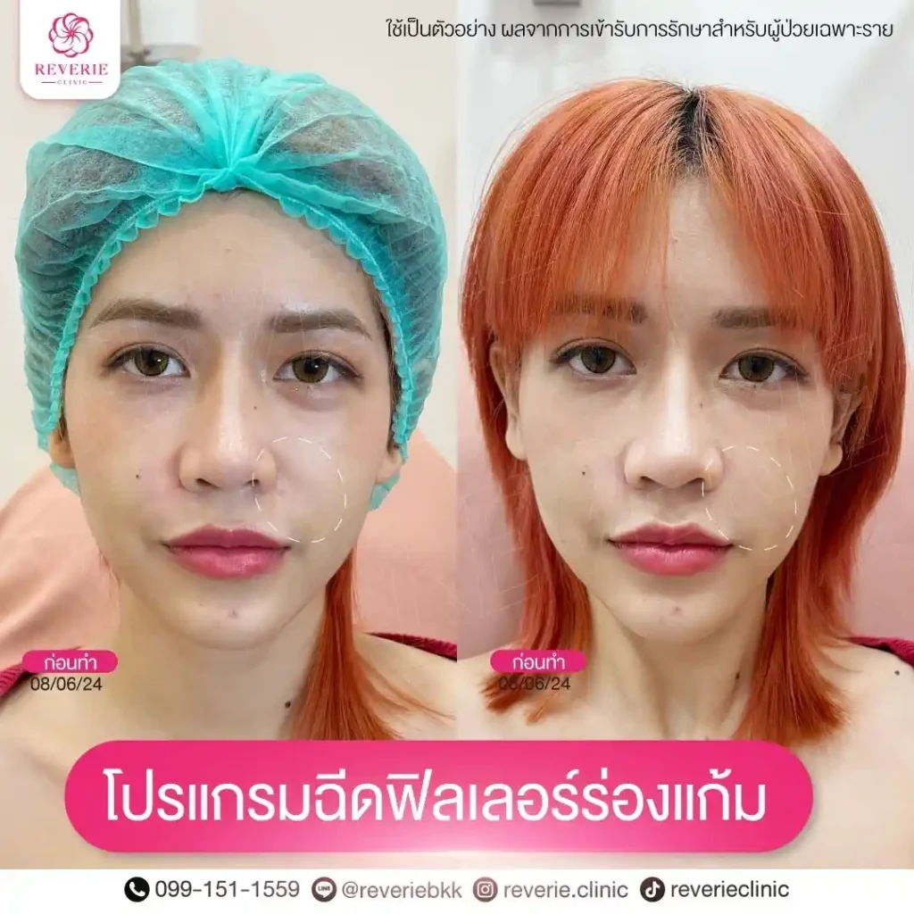 ฟิลเลอร์ร่องแก้ม