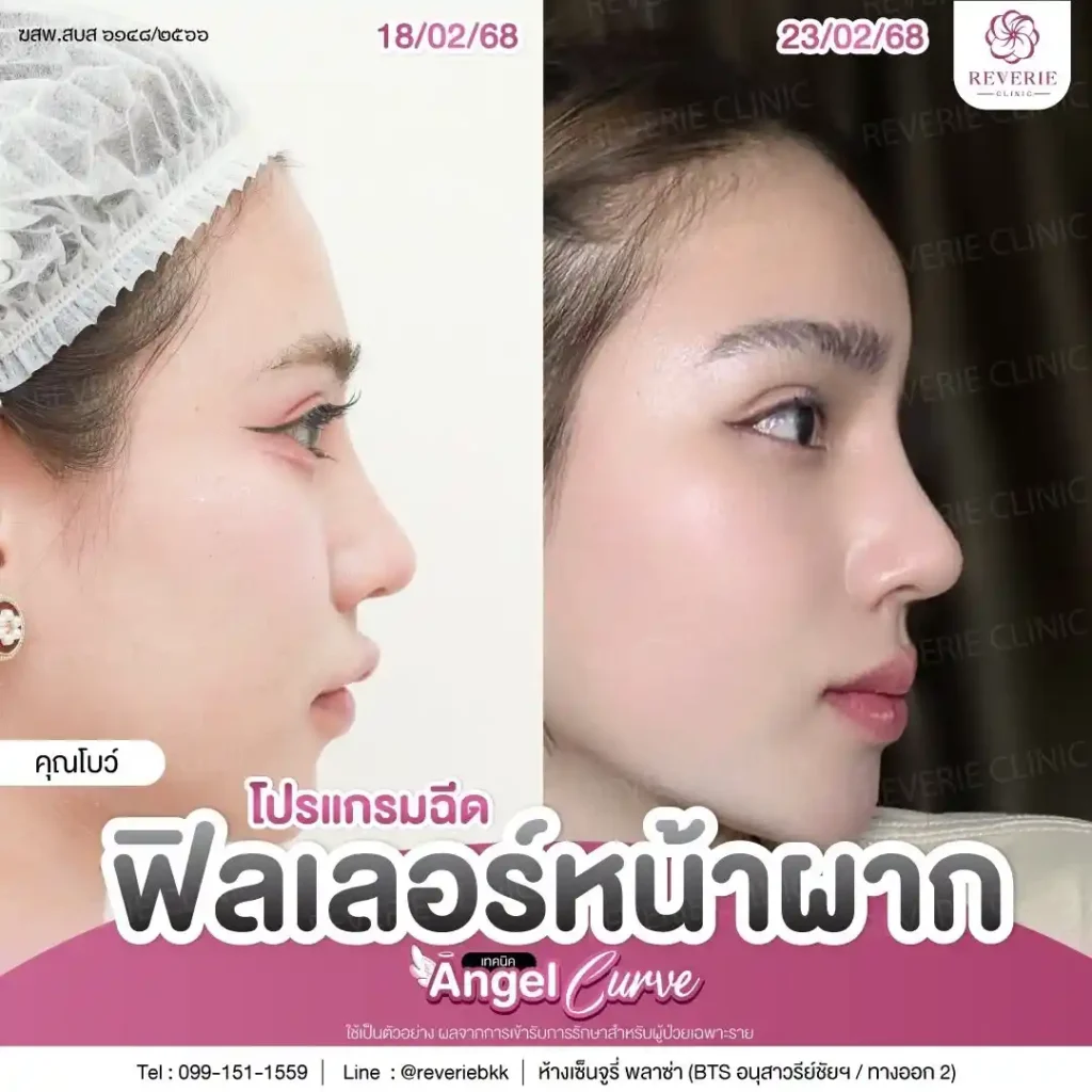 ฟิลเลอร์หน้าผาก 01