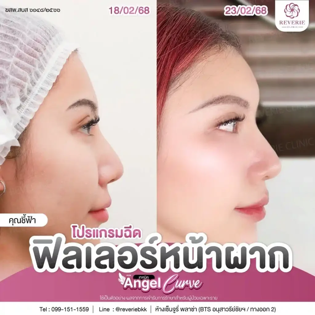 ฟิลเลอร์หน้าผาก 02