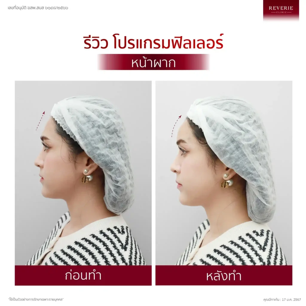 ฟิลเลอร์หน้าผาก 05