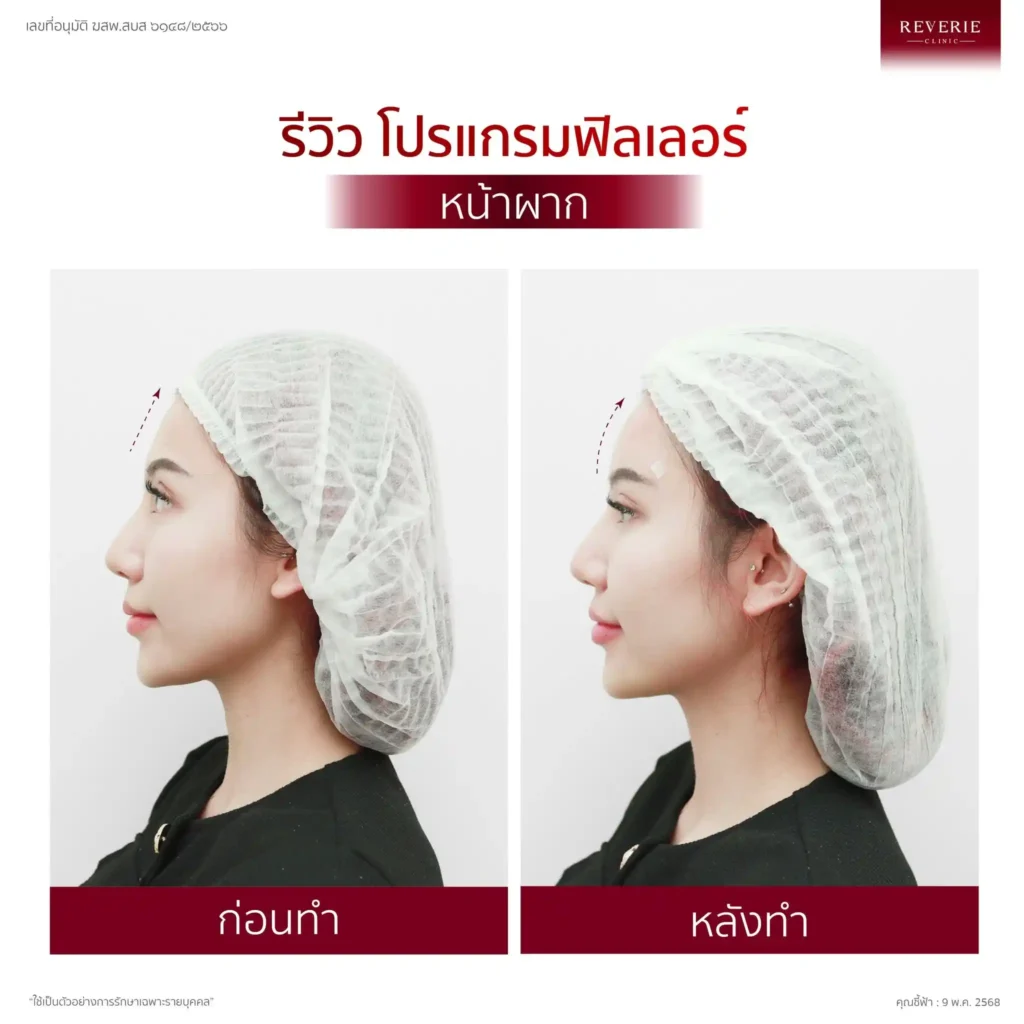 ฟิลเลอร์หน้าผาก 06
