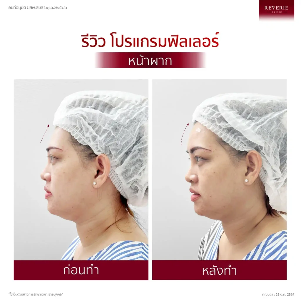 ฟิลเลอร์หน้าผาก 07