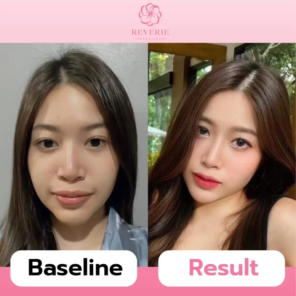 โบท็อกซ์กราม 01