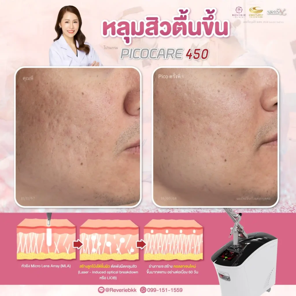 pico laser 02