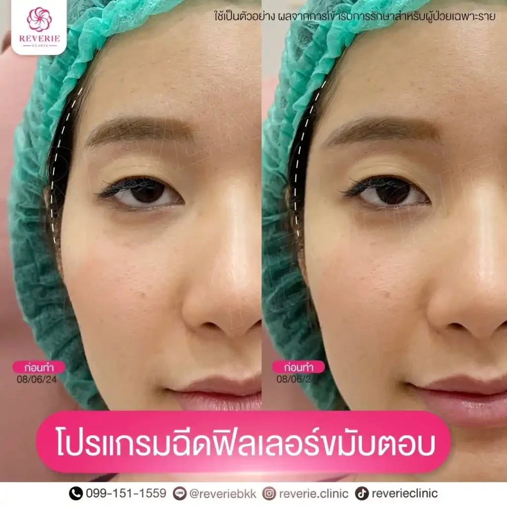 ฟิลเลอร์ขมับ 04